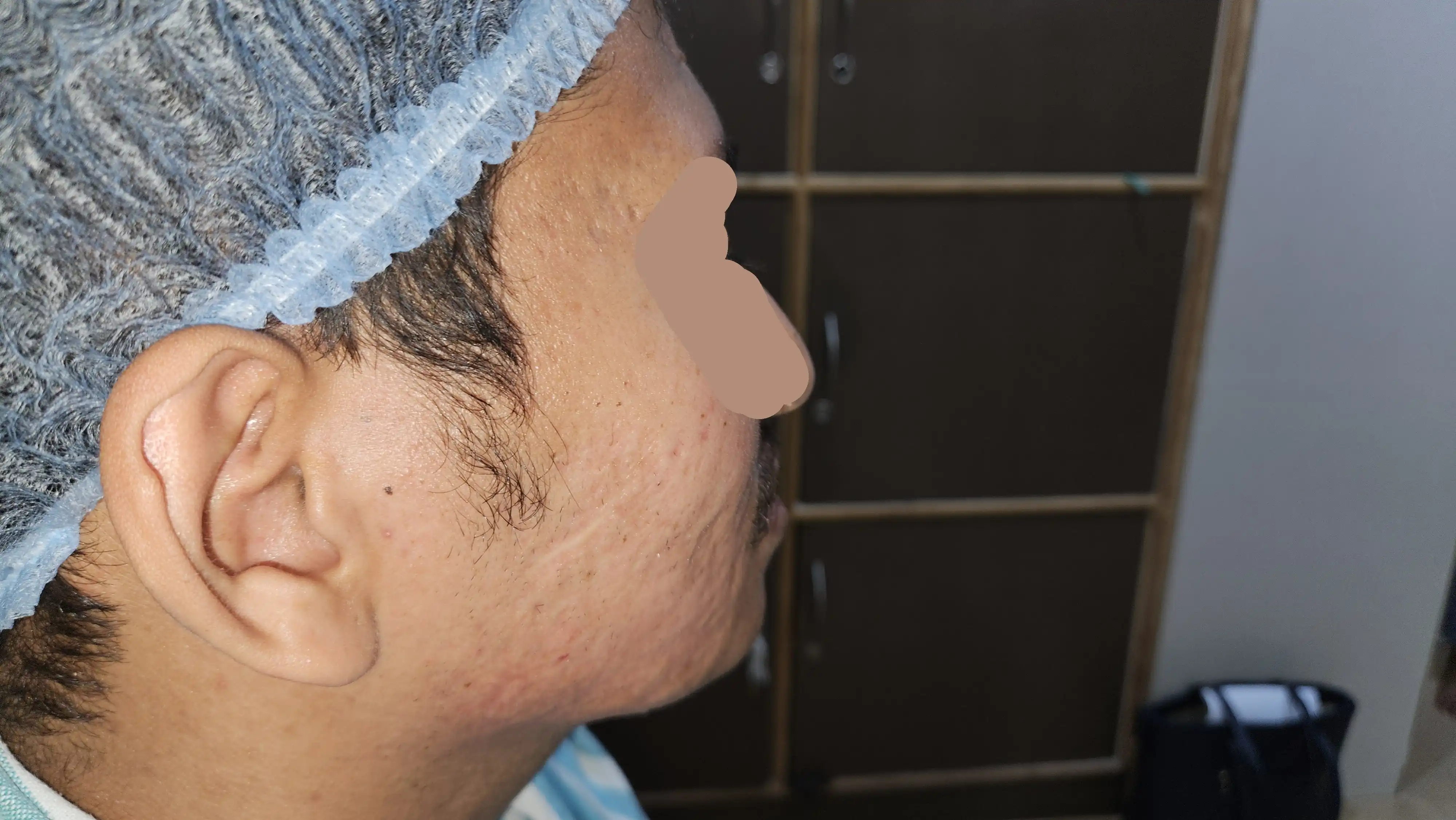 rolling scar subcision